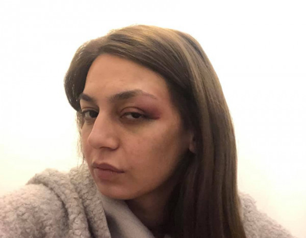 Αστυνομική βία καταγγέλλει βουλευτής του ΜέΡΑ25 – «Δέχθηκα αγκωνιά στο μάτι και χτύπημα με την ασπίδα»