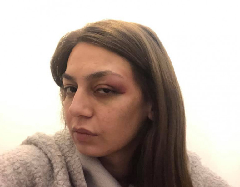 Αστυνομική βία καταγγέλλει βουλευτής του ΜέΡΑ25 – «Δέχθηκα αγκωνιά στο μάτι και χτύπημα με την ασπίδα»