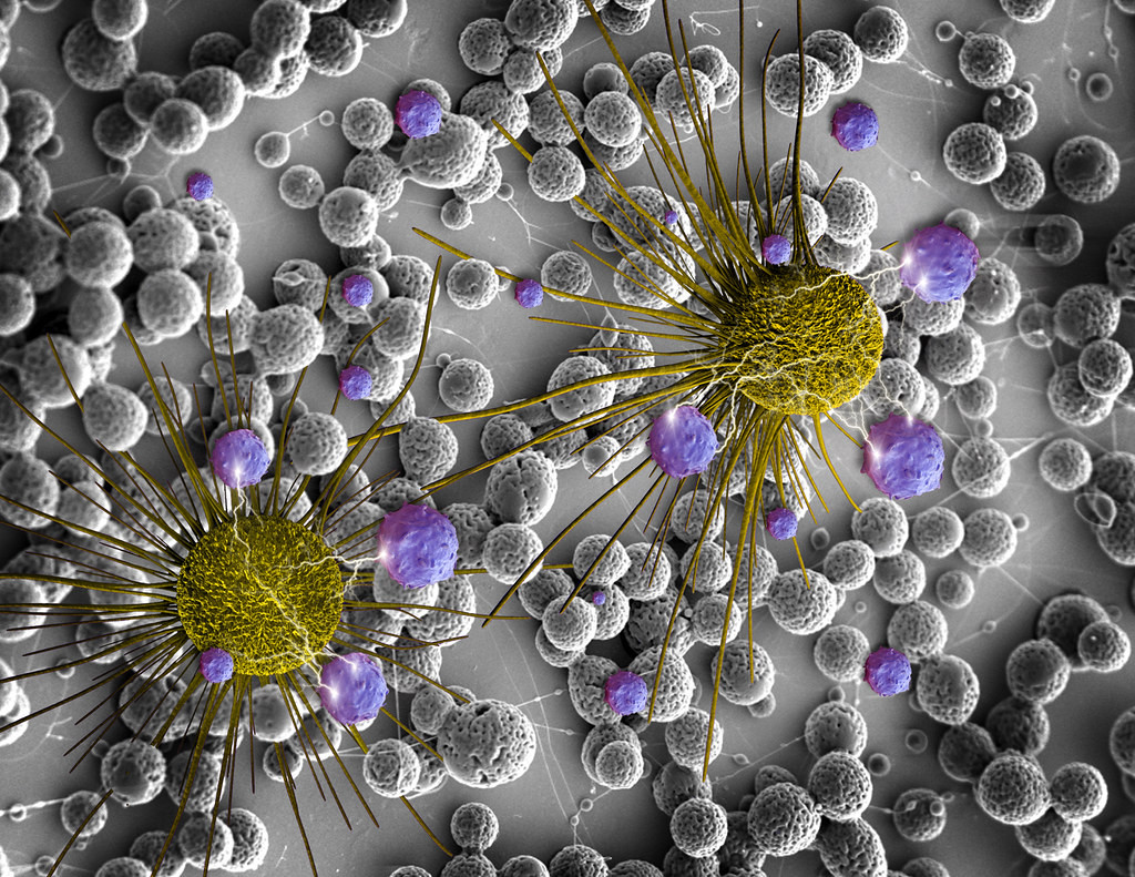 Οι βιοδείκτες προβλέπουν την έκβαση ογκολογικών θεραπειών