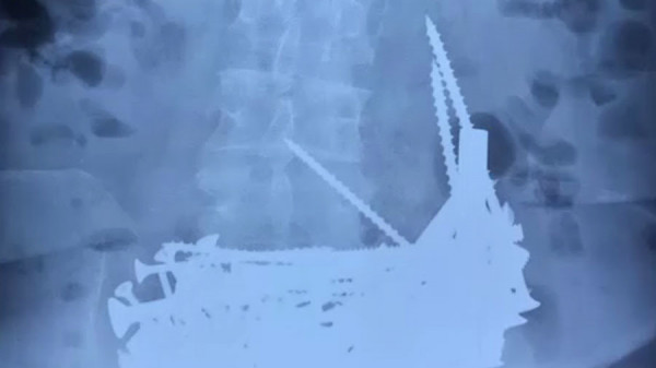 Λιθουανία – Ασθενής είχε στο στομάχι του βίδες και καρφιά πάνω από 1 κιλό