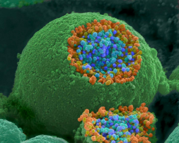 Στην εντατική με κοροναϊό, από γονίδιο υπεύθυνο για την Αλτζχάιμερ