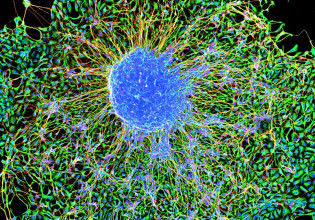 Θεραπείες με βλαστοκύτταρα οδήγησαν 20 ασθενείς στο νοσοκομείο στις ΗΠΑ