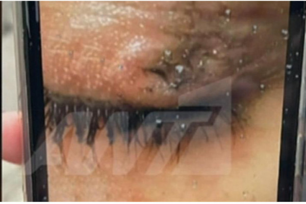 Βία στα σχολεία – 16χρονη έσβησε τσιγάρο στο μάτι συμμαθήτριάς της – Σοκάρει η φωτό