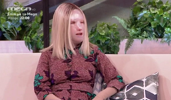 Συγκλονιστική η Ιωάννα Παλιοσπύρου – Όταν έβγαλα για πρώτη φορά τη μάσκα – Η νέα ζωή μου μετά την αποδοχή