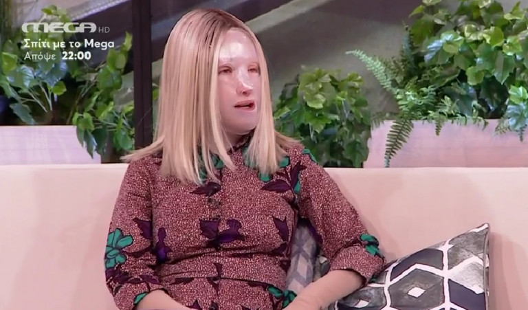 Συγκλονιστική η Ιωάννα Παλιοσπύρου – Όταν έβγαλα για πρώτη φορά τη μάσκα – Η νέα ζωή μου μετά την αποδοχή