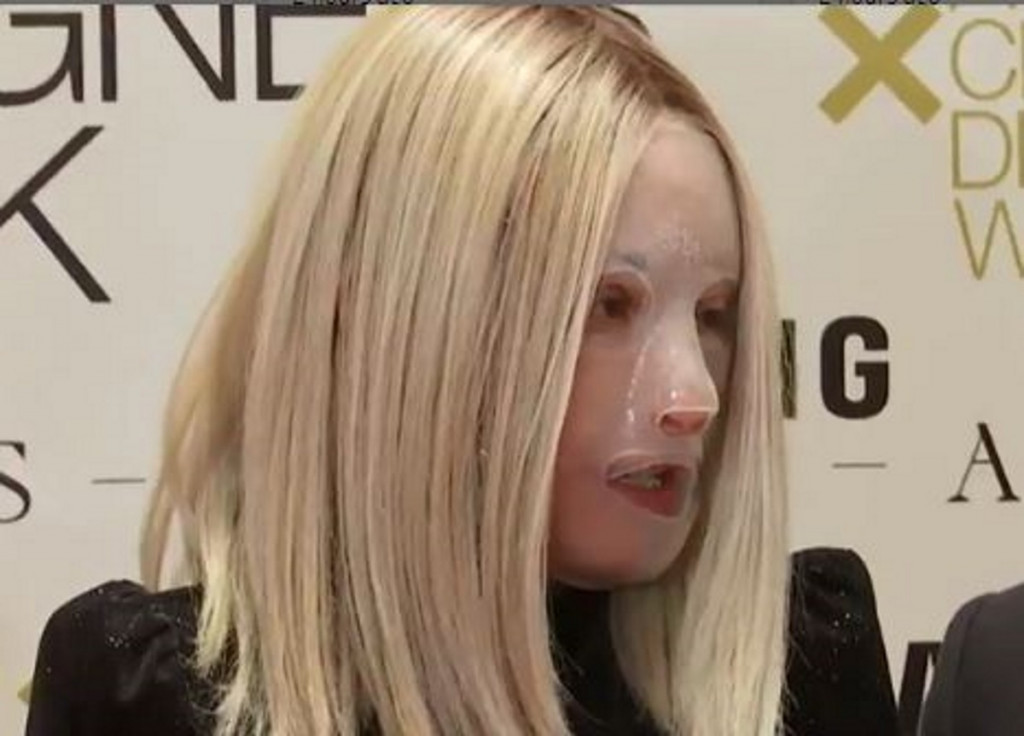 Επίθεση με βιτριόλι – Η πρώτη βραδυνή έξοδος της Ιωάννας μετά τον εφιάλτη