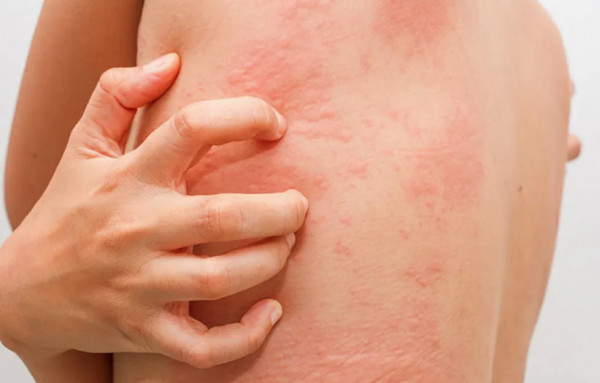 Όμικρον – Ποιο δερματικό πρόβλημα μπορεί να σημαίνει λοίμωξη από τη νέα παραλλαγή