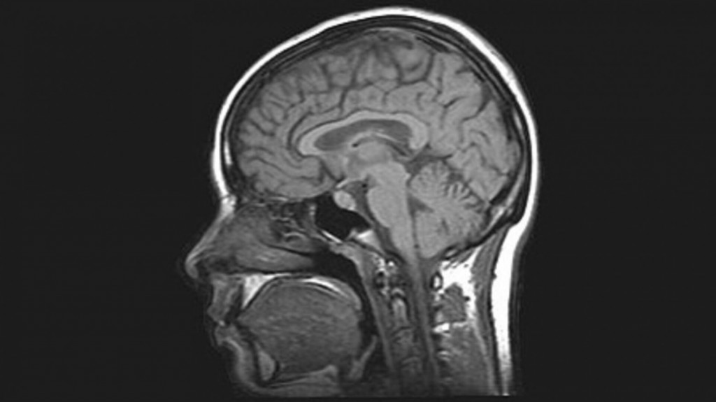 Κοροναϊός – Μελέτη βλέπει εγκεφαλικές βλάβες στο 1% των ασθενών που χρειάζονται νοσηλεία