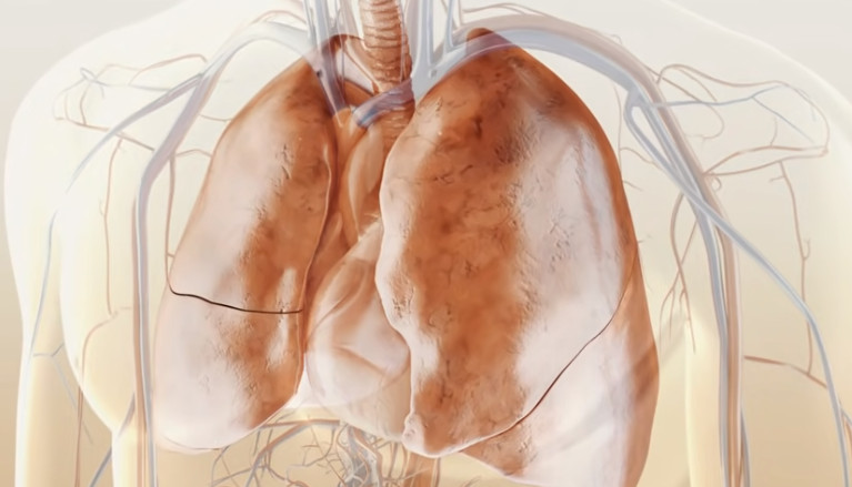 Τριπλός συνδυασμός φαρμάκων δίνει «ανάσα» σε ασθενείς με κυστική ίνωση