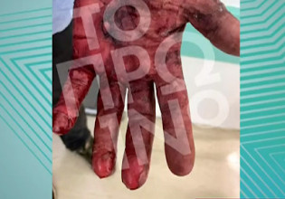 Τζώρτζης Μονογυιός – Σοκάρουν οι εικόνες με τα εγκαύματα του ανθρώπου που απεγκλώβισε αυτόν και τη γυναίκα του