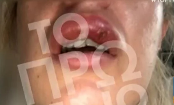 Αγωγή κατά πλαστικού χειρουργού κατέθεσε 38χρονη – Υπέστη βλάβη μετά από επέμβαση στα χείλη