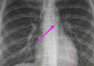 Θεσσαλονίκη: Ανήλικη κατάπιε καρφίτσα – Είχε σταθεί στον δεξιό βρόγχο