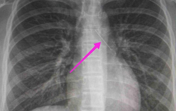 Θεσσαλονίκη: Ανήλικη κατάπιε καρφίτσα – Είχε σταθεί στον δεξιό βρόγχο