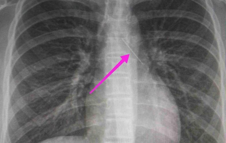 Θεσσαλονίκη: Ανήλικη κατάπιε καρφίτσα – Είχε σταθεί στον δεξιό βρόγχο