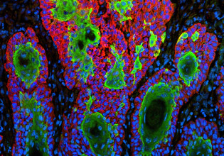 Πανδημία και προγράμματα της Ε.Ε. αλλάζουν την αντιμετώπιση του καρκίνου