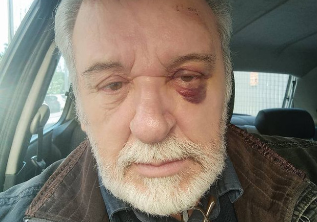Τάσος Χαλκιάς - Οι πρώτες του δηλώσεις για το ατύχημα με το μαυρισμένο μάτι