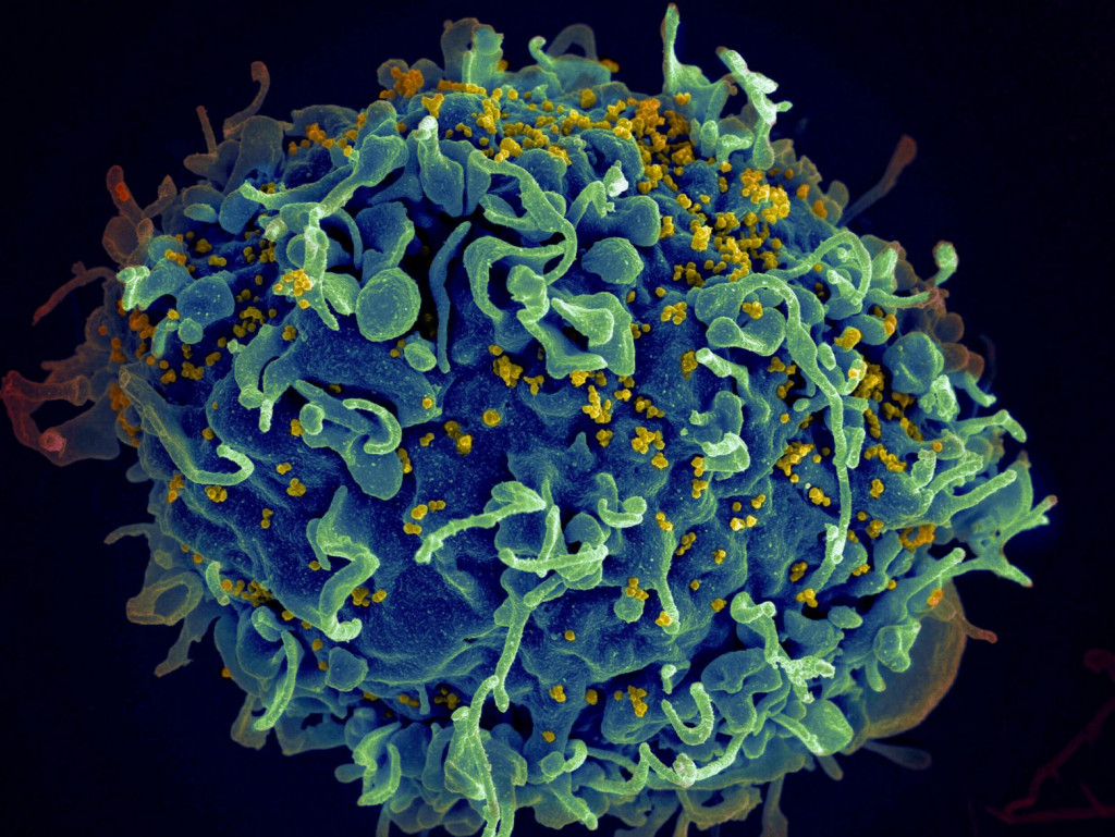HIV: Φάρμακο για τον καρκίνο ίσως ανοίγει το δρόμο για πλήρη ίαση του ιού