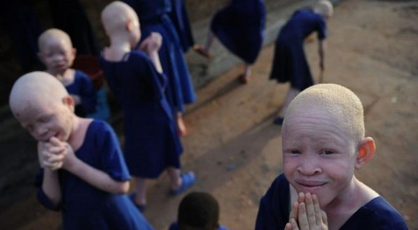 Μπουρούντι: Σοκ με 4χρονο αλμπίνο που βρέθηκε νεκρός και διαμελισμένος