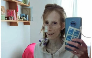 Βρετανία: Πώς ένα λάθος των γιατρών σε γυναίκα με σπάνιο σύνδρομο απειλεί την ζωή της