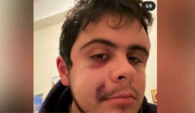 Με χτυπούσαν χωρίς οίκτο, ακόμα και πεσμένο, στο κεφάλι – Καταγγελία 23χρονου για οπαδική βία