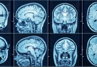 Κοροναϊός: Αλλαγές που παραπέμπουν σε Αλτσχάιμερ ανιχνεύονται σε βαριά ασθενείς