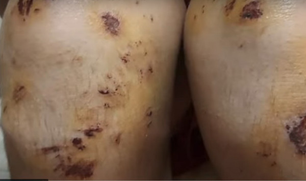 Νέα οπαδική επίθεση-σοκ στη Θεσσαλονίκη: Χτύπησαν με μανία 14χρονο στην παραλία