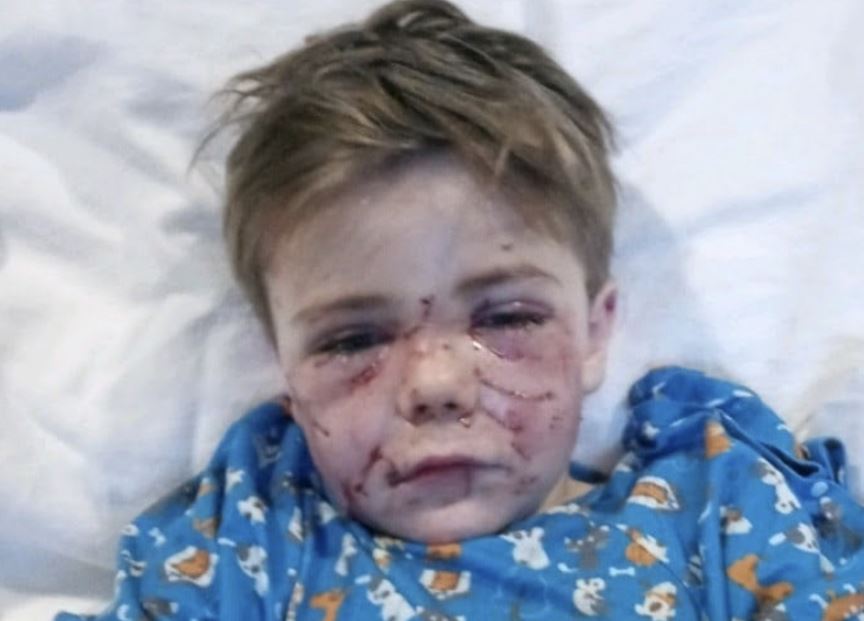 Τέξας: 7χρονο αγοράκι δέχτηκε άγρια επίθεση από σκύλο