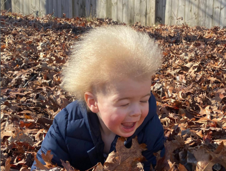 Σύνδρομο αχτένιστων μαλλιών: Το αγοράκι που έχει γίνει viral