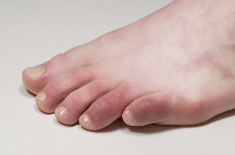 Covid toe: Αλήθεια ή μύθος το ασυνήθιστο σύμπτωμα του κοροναϊού στα δάχτυλα;