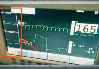 Πάτρα: Η μυστηριώδης βραδυκαρδία της Τζωρτζίνας πριν ειδοποιηθούν οι γιατροί – Εικόνα – ντοκουμέντο