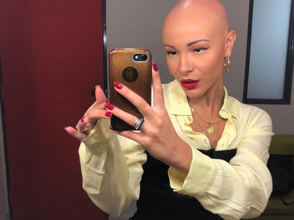 Λυδία Κατσανικάκη: Μιλά για την αλωπεκία και συγκινεί – «Μία ημέρα ξύπνησα και…»