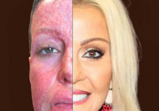 Αυστραλία: Γυναίκα της έβαλε φωτιά, επειδή την ζήλευε – Η απίστευτη μεταμόρφωσή της μετά από 200 επεμβάσεις