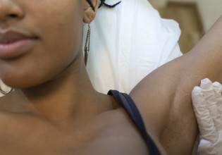 Laser αποτρίχωσης: Πόσο μόνιμα είναι τα αποτελέσματά της;