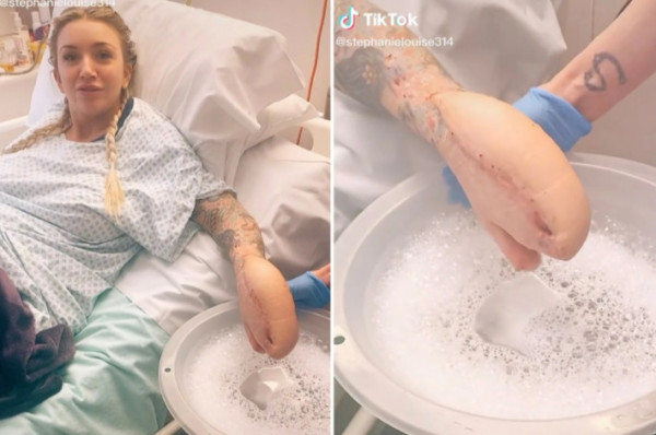 Το «χέρι-καρχαρίας» σπάει ρεκόρ στο Tik Tok με 75 εκατ. προβολές – Η τραγική ιστορία της Κέμπ