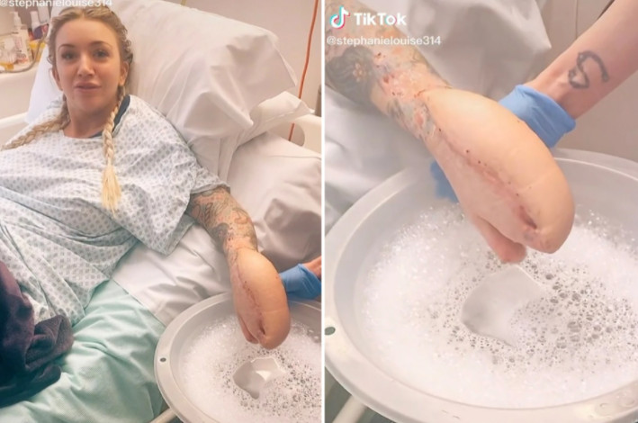 Το «χέρι-καρχαρίας» σπάει ρεκόρ στο Tik Tok με 75 εκατ. προβολές – Η τραγική ιστορία της Κέμπ