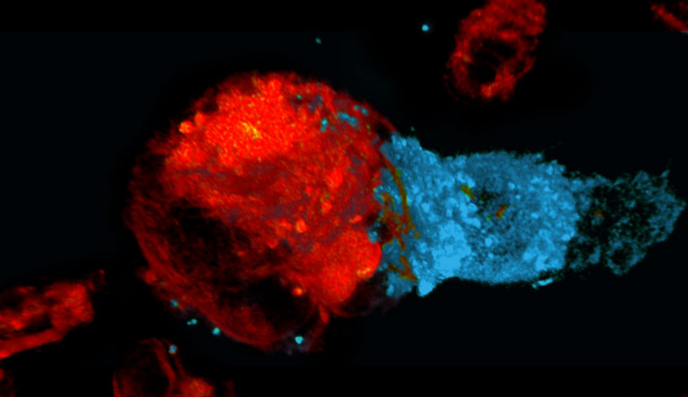 Νέα γενιά θεραπειών στοχεύει στο προφίλ της ασθένειας και του ασθενή