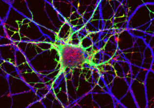 Πολλαπλή σκλήρυνση: Άκρως ενθαρρυντικά αποτελέσματα από πειραματική θεραπεία