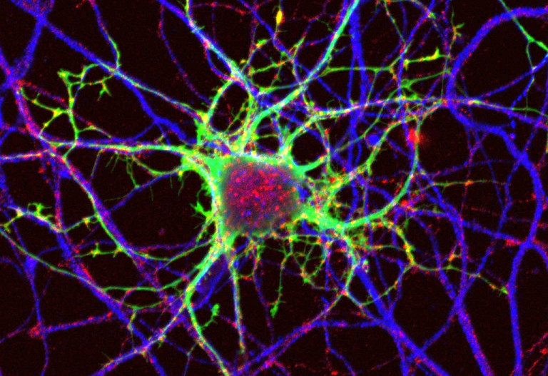 Πολλαπλή σκλήρυνση: Άκρως ενθαρρυντικά αποτελέσματα από πειραματική θεραπεία