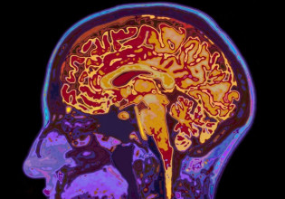 Κοροναϊός: Η άνοια «παραμονεύει» μετά τη βαριά νόσο – Οι συστάσεις των ειδικών