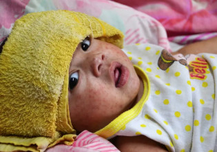 Ιλαρά: Δραματική αύξηση κρουσμάτων λόγω μείωσης των εμβολιασμών