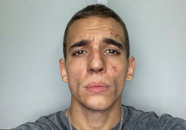 Κάηκε στο σπίτι του «Ρίο» από το «La Casa de Papel» – Πήδηξε από το παράθυρο για να σωθεί