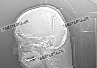 Καλαμπάκα: Καρφί 5 εκατοστών σφηνώθηκε στο κεφάλι άνδρα