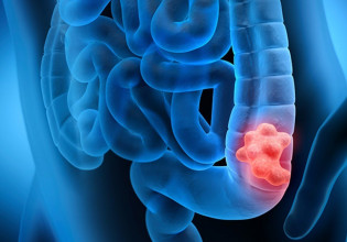 H τεχνητή νοημοσύνη καλύτερη από τους γιατρούς στην κολονοσκόπηση