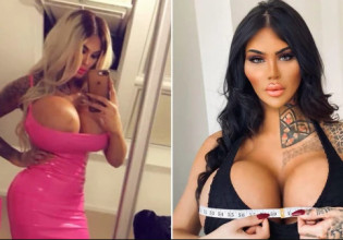 Βρετανία: Μοντέλο έχει υποβληθεί σε 23 χειρουργικές επεμβάσεις καλλωπισμού σε 6 χρόνια