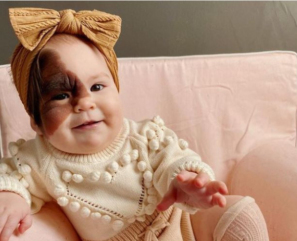 To σπάνιο σημάδι στο πρόσωπο της μικρής Winry γίνεται δύναμη για όλους