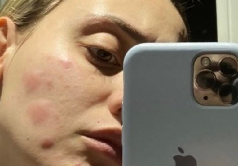 Συγκλονίζει η Άννα Κορακάκη: «Έτσι βίωσα το stalking» – Γροθιά στο στομάχι οι φωτογραφίες με τα σημάδια