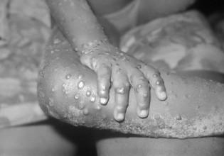 Βρετανία: Παγκόσμιος συναγερμός για την «ευλογιά των πιθήκων» – Τέσσερα νέα κρούσματα