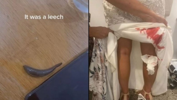 Αυστραλία: Πώς μια βδέλλα παραλίγο να… διαλύσει ολόκληρο γάμο