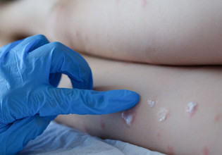 Ζαούτης για ευλογιά των πιθήκων: Αυξημένη επαγρύπνηση, αλλά όχι ανησυχία