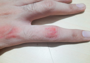 Ρευματοειδής αρθρίτιδα: Καλύτερη θεραπεία η συνεργασία γιατρού – ασθενή